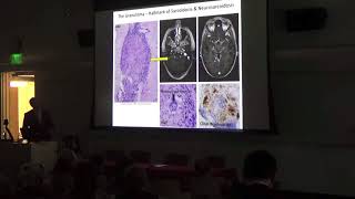 Neurosarcoidosis Jeff Gelfand [upl. by Burg502]