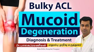 ACL Mucoid Degeneration in Knee  Diagnosis amp Treatment  Dr Balasubramanian MS Ortho [upl. by Finley]