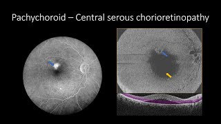 Structural Enface OCT Choroidal vascular and Bruch’s membrane PED and Pachychoroid [upl. by Anairad326]