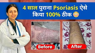 Psoriasis को कैसे ठीक करें  Skin Psoriasis Treatment  Dr Upasana Vohra Patient Review [upl. by Nylanej566]