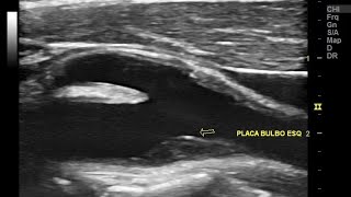 Indicações do Duplex Scan das Carótidas e quem pode fazer Escleroterapia com espuma [upl. by Germana84]