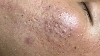 ACNE TREATMENT VU QUYNH MI  Blackheads On Boy Face 2024FULL [upl. by Hubing]