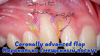 Лечение рецессии десны методом КСЛ  Coronally advanced flap for single gum recession treatment [upl. by Ihteerp]