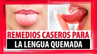 REMEDIOS CASEROS PARA LENGUA QUEMADA  COMO CURAR LA LENGUA QUEMADA [upl. by Enirtak]