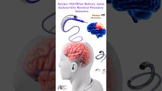 Stryker AXS Offset Delivery Assist Catheter Clot Retrieval Procedure Animation 3d animation short [upl. by Eignat484]