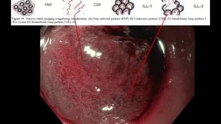 Imaging of a poorly differentiated adenocarcinoma of the stomach with signet ring cells [upl. by Neelear]