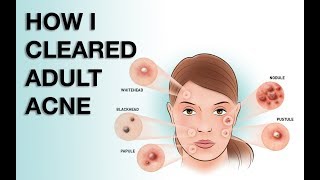 WHERE HAVE YOU BEEN Aka HOW I CLEARED MY ADULT ACNE [upl. by Rimahs]