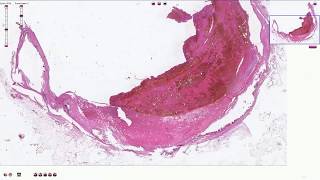 Atheromatous Plaque with Thrombosis  Histopathology [upl. by Anerok]