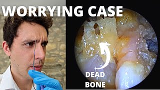 Dead Bone And Infection In Ear Cavity Mastoid Sequestrum And Granulation [upl. by Eyeleen140]