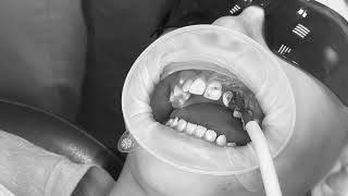 Impacted tooth extraction [upl. by Nhguavaj]