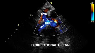 Bidirectional Glenn Procedure Echocardiography [upl. by Mcquoid]