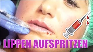 Lippen aufspritzen mit Hyaluronsäure 💉 Vorher Nachher  stündliche Updates 💋 Nickisbeautyworld [upl. by Erot204]