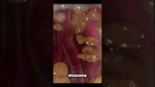 helicobacter pylori infection [upl. by Aerdma]