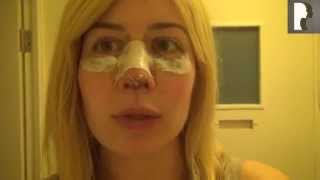 UPDATE Revision Rhinoplasty Video Diary  Day 3 After Surgery [upl. by Kaspar]