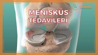 MENİSKÜS SORUNLARI VE MENİSKÜS TEDAVİLERİ [upl. by Eilegna760]