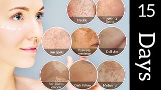 Melasma  Hyperpigmentation treatment  Dark spot Uniquetipsbykanza [upl. by Leboff935]