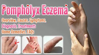 Pompholyx eczema causes symptoms diagnosis treatment home remedies FAQ  Dyshidrotic eczema [upl. by Alica]