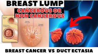 BREAST LUMP Cancerous VS Non  Cancerous  Duct Ectasia or Breast Cancer  Detailed Video [upl. by Jervis419]