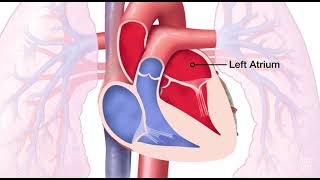 Mitral Valve Regurgitation [upl. by Skvorak]