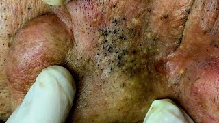 PIMPLE Popping BLACKHEAD REMOVAL 2022 ACNE Treatment TOP RELAXING SPA VIDEO 2022 8 [upl. by Ykcul]