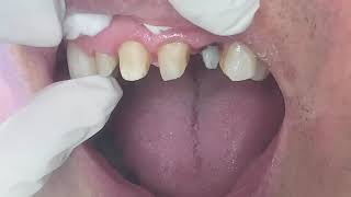 Houston Cosmetic DentistYes you can disguise that discolored front Root Canal tooth [upl. by Deedee]