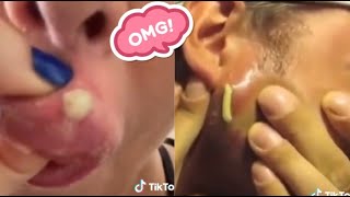 Satisfying Blackhead Removal Compilation  Best Techniques for Clear Skin [upl. by Jentoft623]