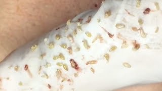 How To Remove Blackheads And Whiteheads On Face Easy 41 ✦ Dr Laelia ✦ [upl. by Adnohral]