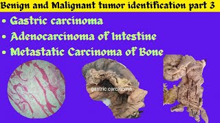 Gastric carcinoma Adenocarcinoma of Intestine Metastatic tumor of Bone identification Patho OSPE [upl. by Anallij]