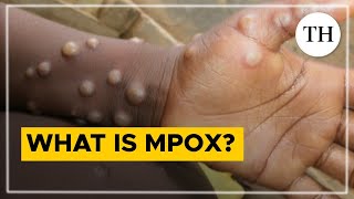 What is mpox  The Hindu [upl. by Omissam]