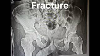 pelvic fracture fracture  sn radiology [upl. by Eyak]