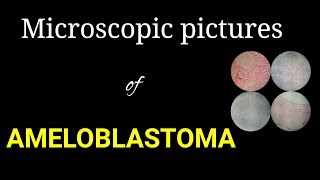 Microscopic histology of ameloblastoma microscopic pictures of oral pathology Dr Poojireddy [upl. by Chuck]