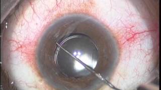 Reposition of subluxated IOL [upl. by Asirrac]