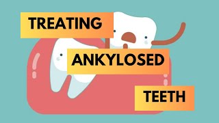 Management of Ankylosed Teeth  Orthodontics [upl. by Drarreg]