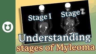 How does a patient know the stage of myeloma myeloma [upl. by Ztnarf]