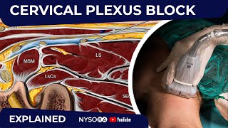 Cervical Plexus Block  Regional anesthesia Crash course with Dr Hadzic [upl. by Aneloaup542]