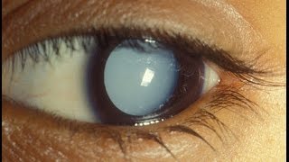 Cataract Aphakia and Pseudophakia Examination [upl. by Atalanti]