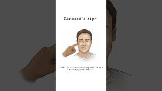 Chvosteks sign kattrucate hypocalcemia tetanus twitching signs medicalshorts medicalstudent [upl. by Arikat]