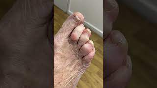 Discover how a scalpel transforms feet Aussie podiatrist tackles corns amp hard skin [upl. by Basilio890]