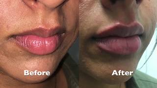 Lip Augmentation Using Juvederm Ultra Plus XC Performed By Dr Joshua D Zuckerman MD FACS [upl. by Urbanna]