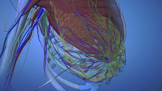 Predicting Progression of DCIS to Invasive Cancer [upl. by Sylvan]