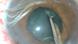 Cataract with Posterior Synechiae by Pradip Mohanta Netrajyoti Eye Hospital [upl. by Nnyw]