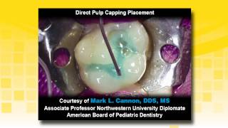 TheraCal LC as a Liner in a Class II Resin Based Composite Restoration [upl. by Ola]