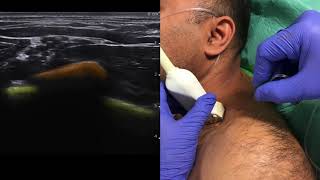 Infraclavicular Nerve Block  UltrasoundGuided Demonstration [upl. by Standice]