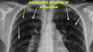 Chest xray features of Pulmonary Hypertension and Aortic Dissection  Cardiology  Medicine [upl. by Krystal]