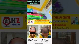 How do you use leech oil for hair growth  PURE LEECH OIL 50 ml Mrp  ₹250 kzhijamaleechoildr [upl. by Sisile605]