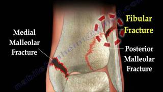 Ankle fracture  Fractures and its repair Everything You Need To Know  Dr Nabil Ebraheim [upl. by Eynobe]