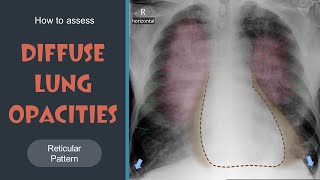 How to assess Diffuse Lung Opacities  Reticular pattern  Lec 13 [upl. by Glass177]