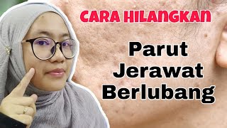 Cara Merawat Parut Jerawat Berlubang Berkesan [upl. by Nel]