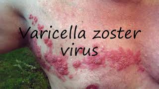 How to Pronounce Varicella zoster virus [upl. by Bronny]