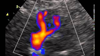 intracranial vertebral arteries and basilar artery transcranial color Doppler [upl. by Orozco]